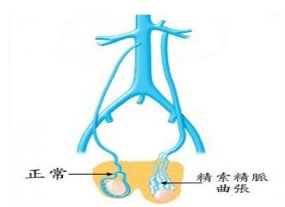 精索靜脈曲張會導(dǎo)致多大的傷害