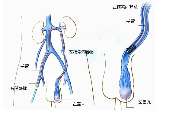 男性如何預(yù)防精索靜脈曲張